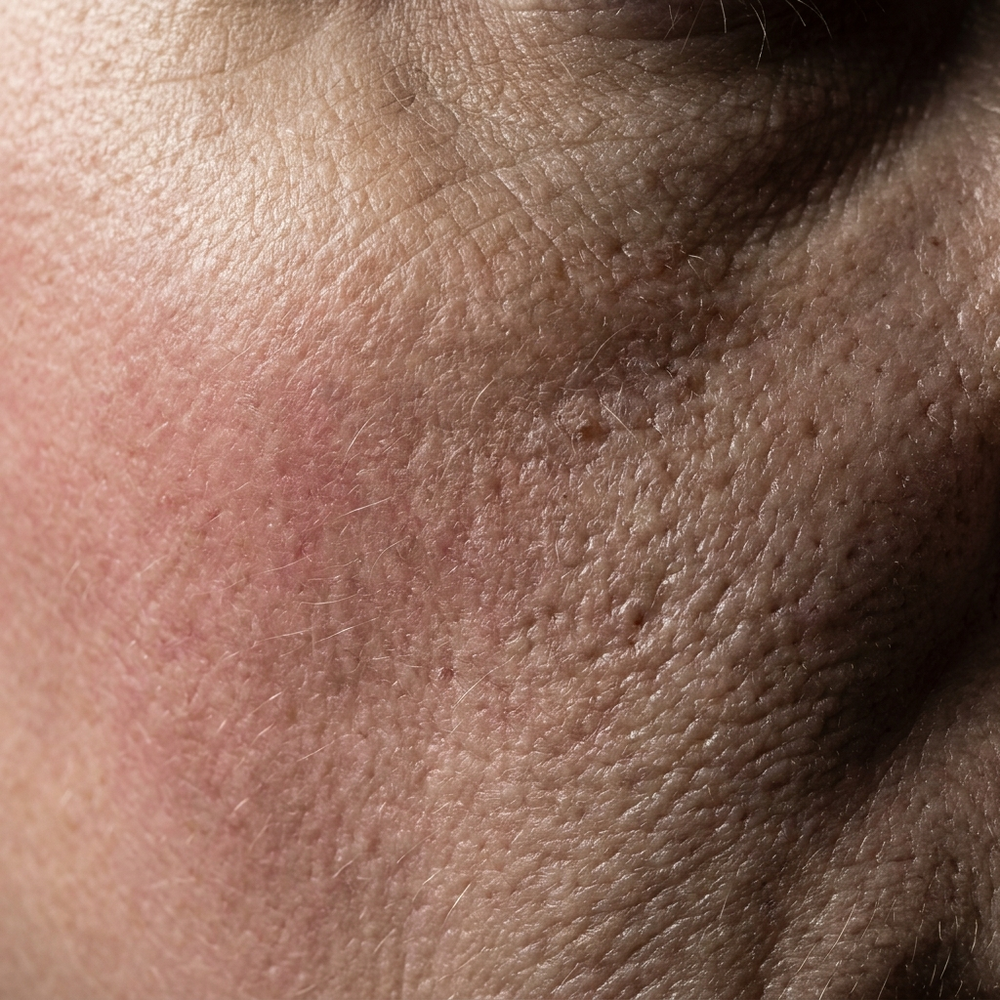 6. Skin Microbiome Shifts and the Inflammation Cascade Will Not Quiet Down