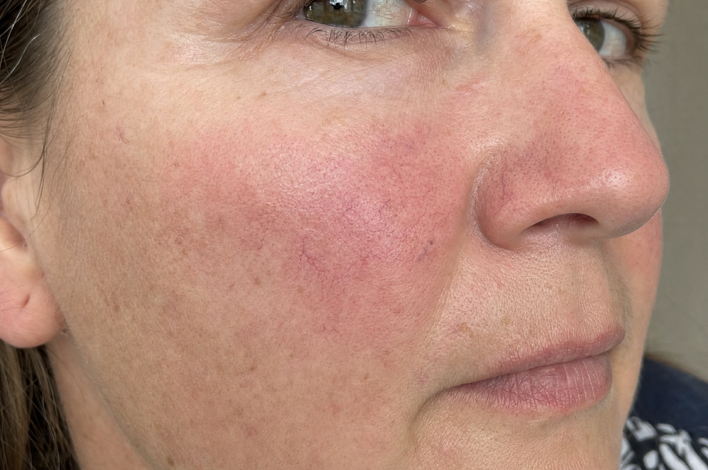 Red Flag #2. Capillaries Showing Through Your Cheeks